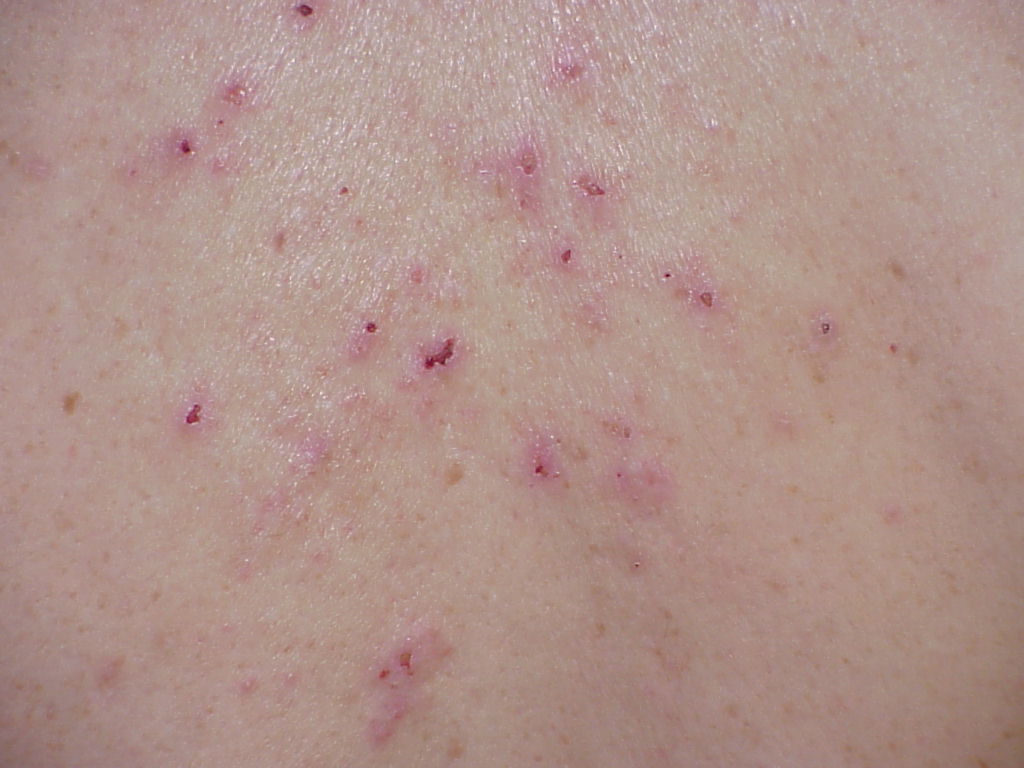 skin rash disease #10